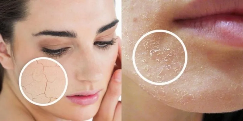 Da đang tổn thương, viêm, bong tróc hoặc vừa thực hiện thủ thuật cần thận trọng khi dùng nha đam