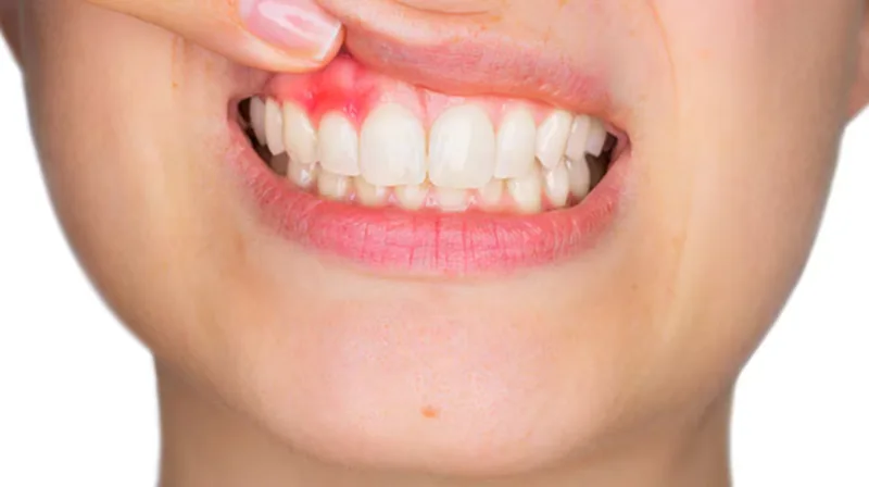 Người có răng ê buốt, sâu răng, viêm nướu, răng nứt hoặc nhiều phục hình nên thận trọng trước khi tự làm trắng răng tại nhà.
