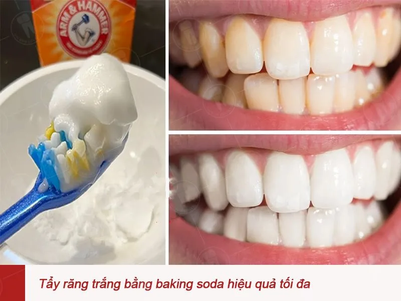 Cách làm trắng răng bằng Baking Soda chủ yếu hỗ trợ làm sạch một phần vết ố ngoại sinh trên bề mặt, chứ không làm thay đổi mạnh màu răng tự nhiên bên trong.